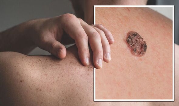 Melanoma