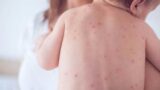 Morbillo, allarme nel Lazio, aumentano i contagi: sintomi, cure e vaccini