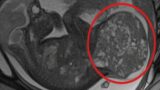 Roma, neonata con tumore da 800 grammi salvata dai medici: ‘Presto tornerà a casa’