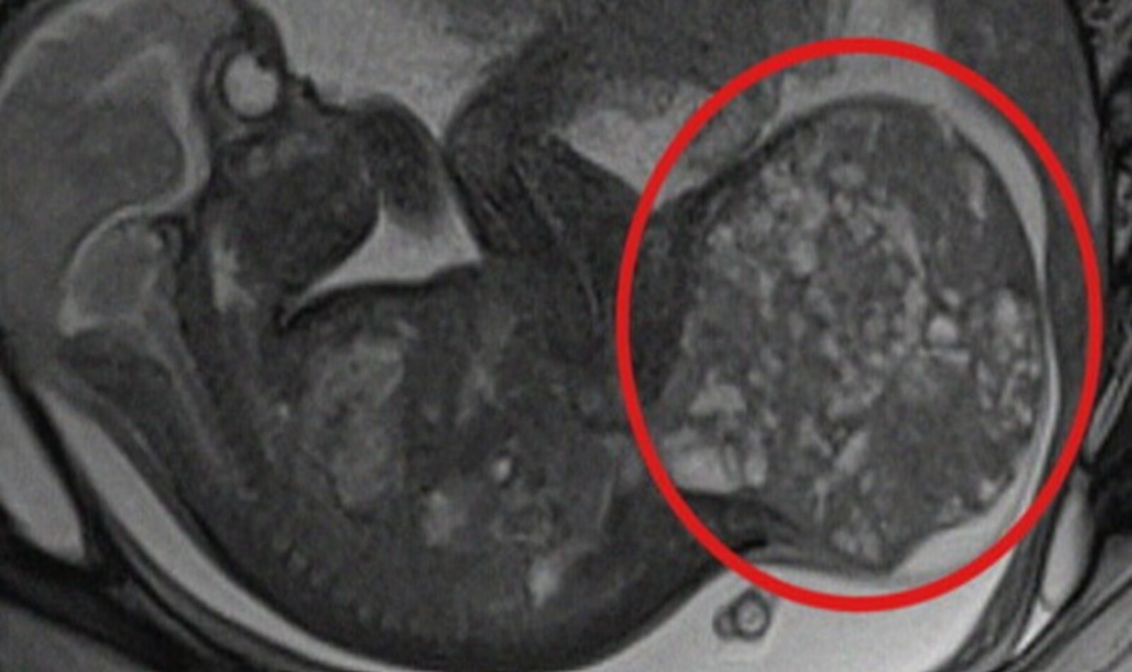 Neonata tumore Roma