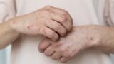 Morbillo a Roma, perché febbre e rash non vanno sottovalutati